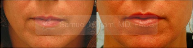 Lip Augmentation Photos
