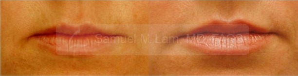 Lip Augmentation Photos