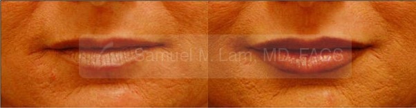 Lip Augmentation Photos