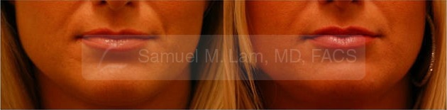 Lip Augmentation Photos