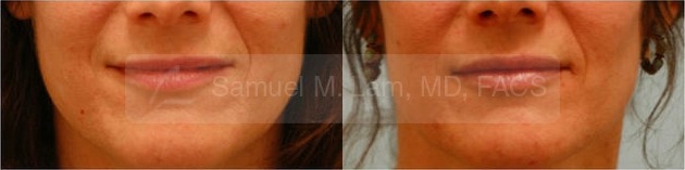 Lip Augmentation Photos
