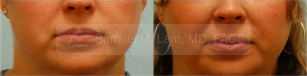Lip Augmentation Photos