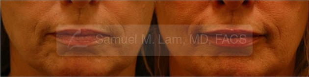 Lip Augmentation Photos