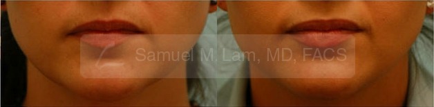 Lip Augmentation Photos