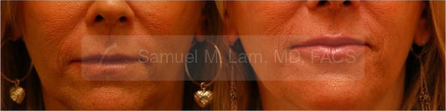 Lip Augmentation Photos