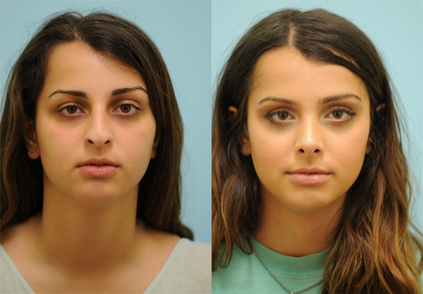 Hooked Nose Rhinoplasty Photos