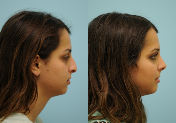 Hooked Nose Rhinoplasty Photos