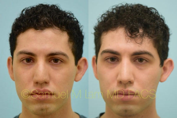 Hooked Nose Rhinoplasty Photos