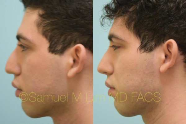 Hooked Nose Rhinoplasty Photos