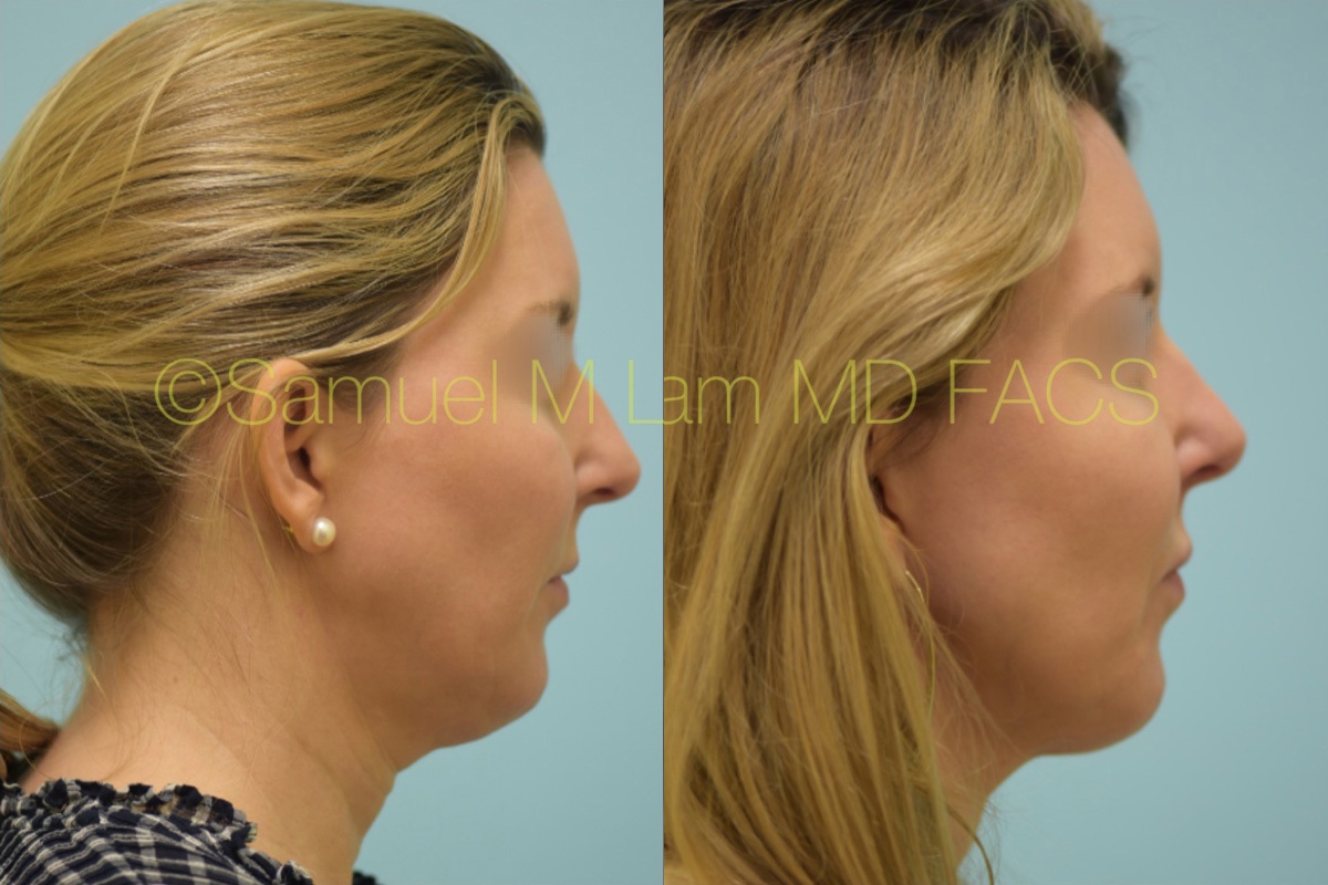 Hooked Nose Rhinoplasty Photos
