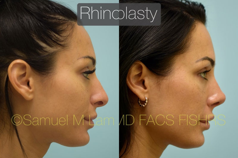 Hooked Nose Rhinoplasty Photos