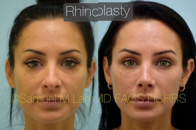 Hooked Nose Rhinoplasty Photos