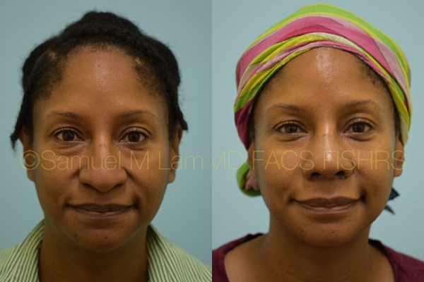 Hooked Nose Rhinoplasty Photos