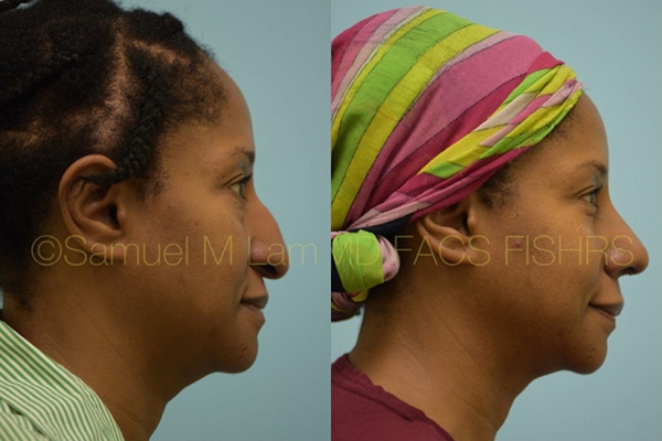 Hooked Nose Rhinoplasty Photos