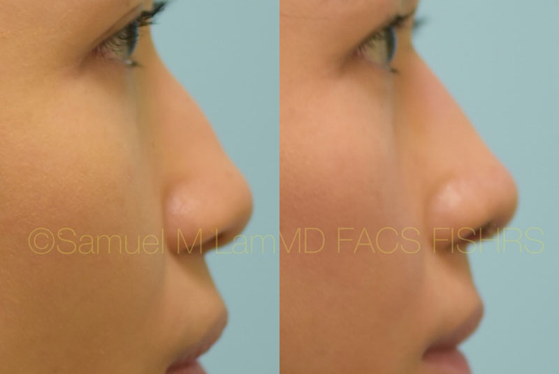 Hooked Nose Rhinoplasty Photos