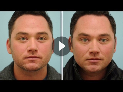 Lip Augmentation Videos