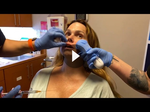 Lip Augmentation Videos