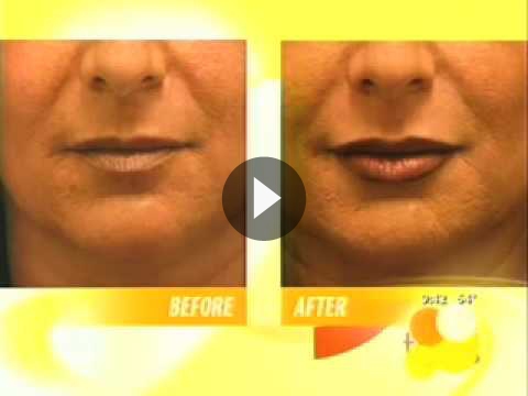 Lip Augmentation Videos