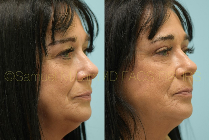 Eyelid Rejuvenation
