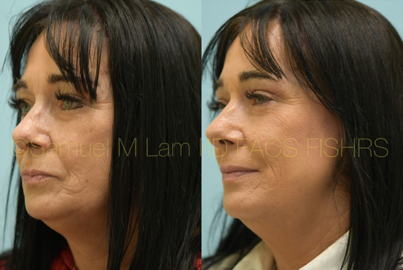 Eyelid Rejuvenation