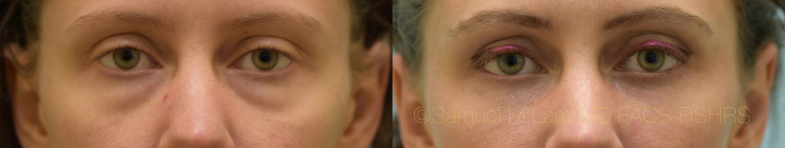 Eyelid Rejuvenation, Fat Grafting