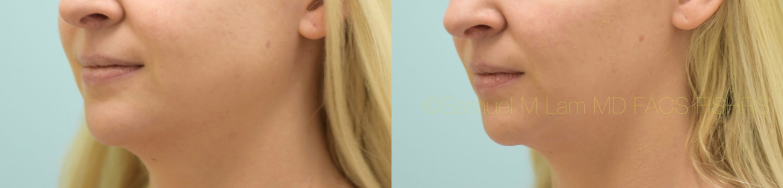 Botox Jaw Reduction