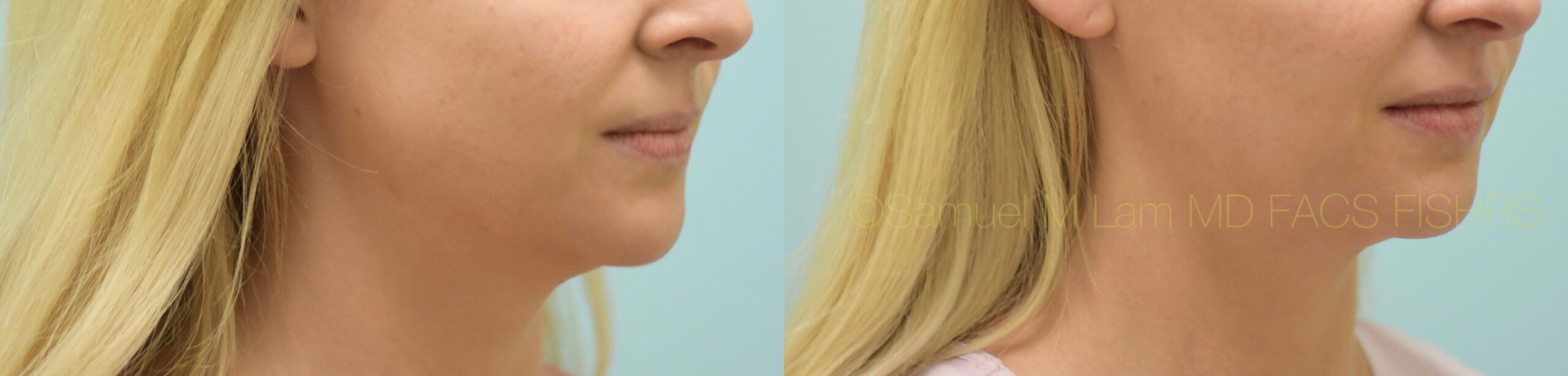 Botox Jaw Reduction