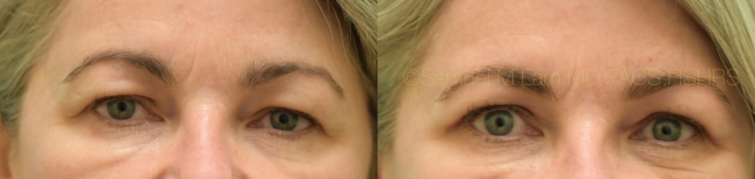 Eyelid Rejuvenation
