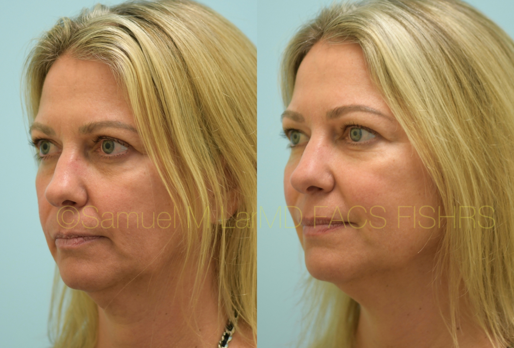 Botox