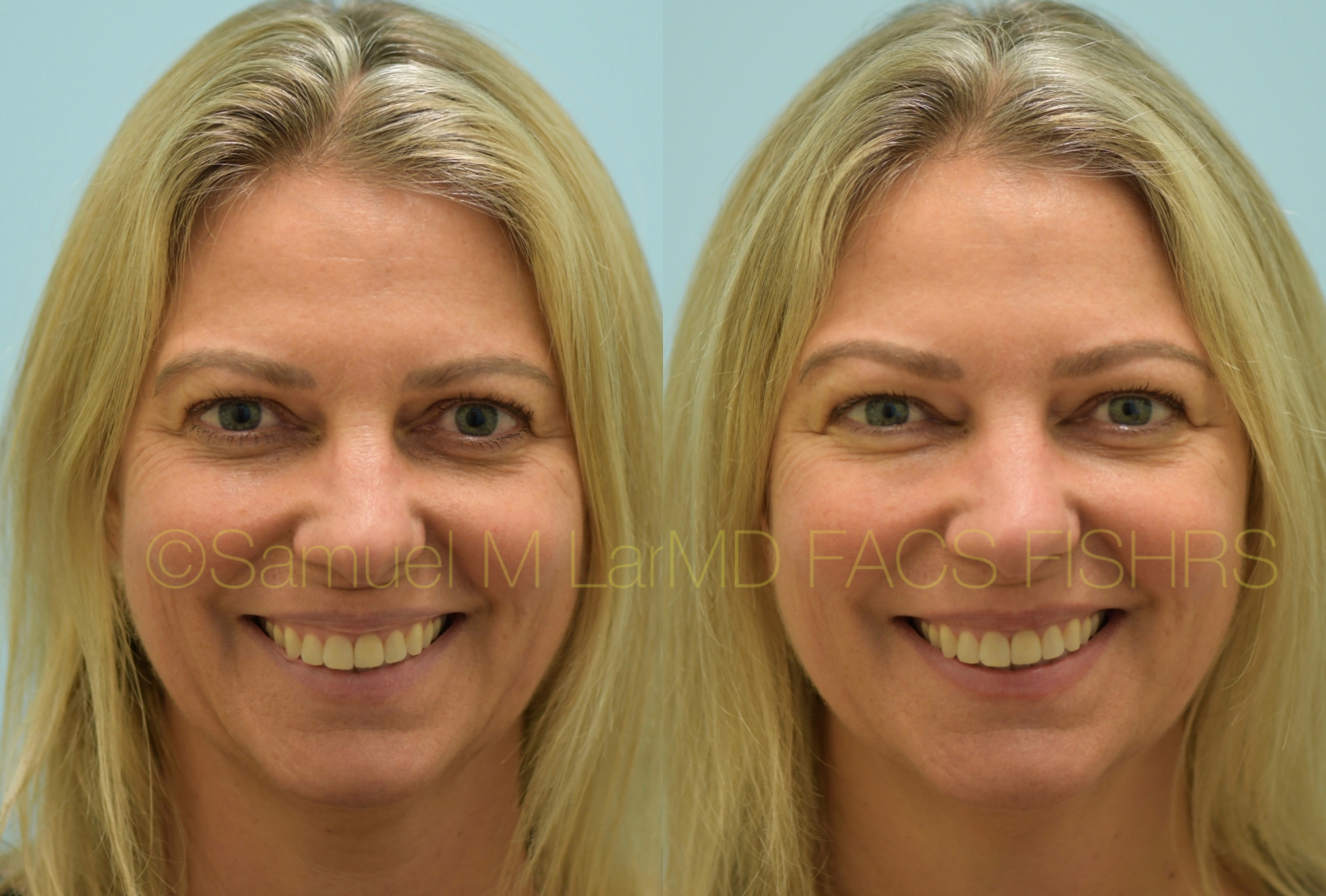 Botox