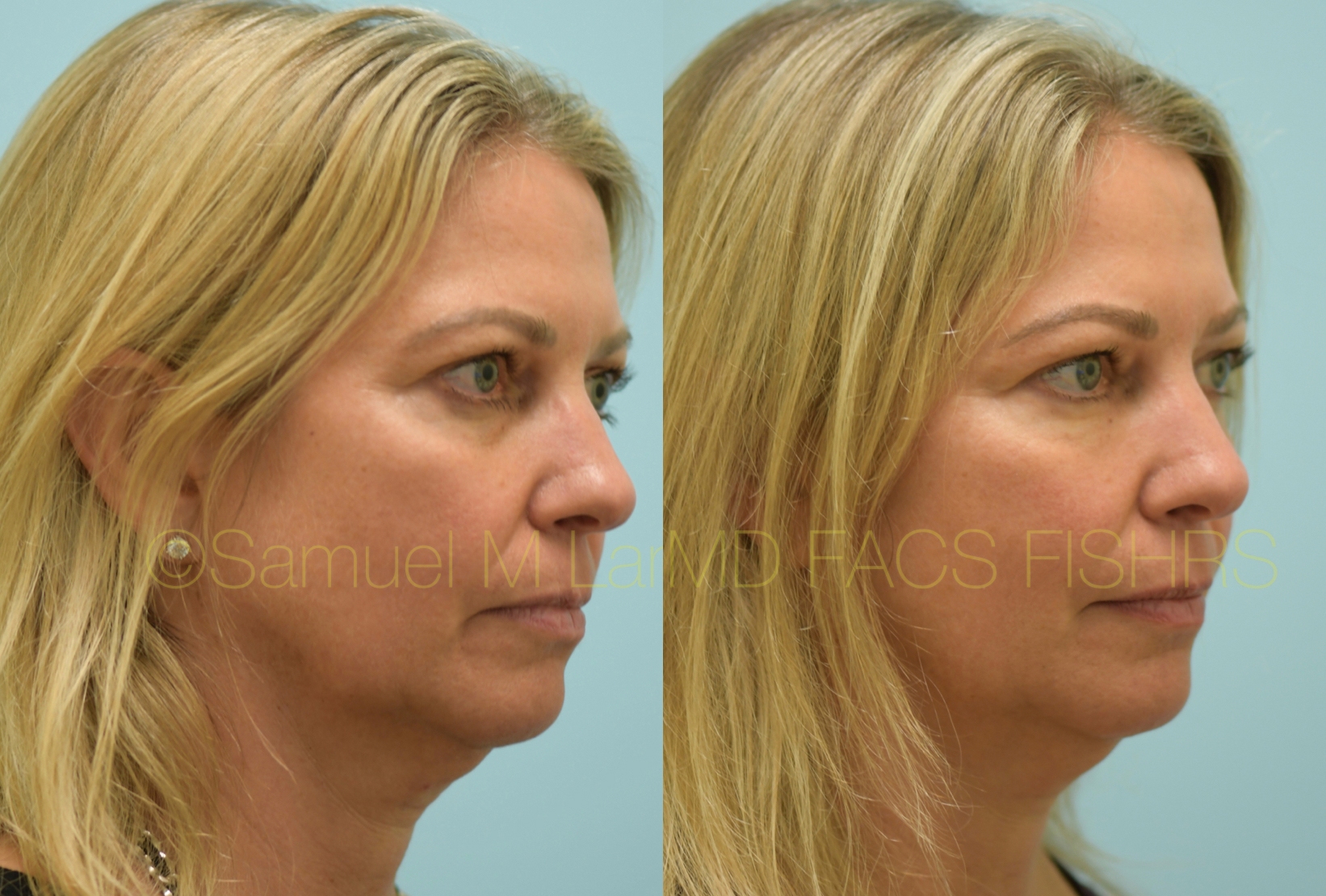 Botox