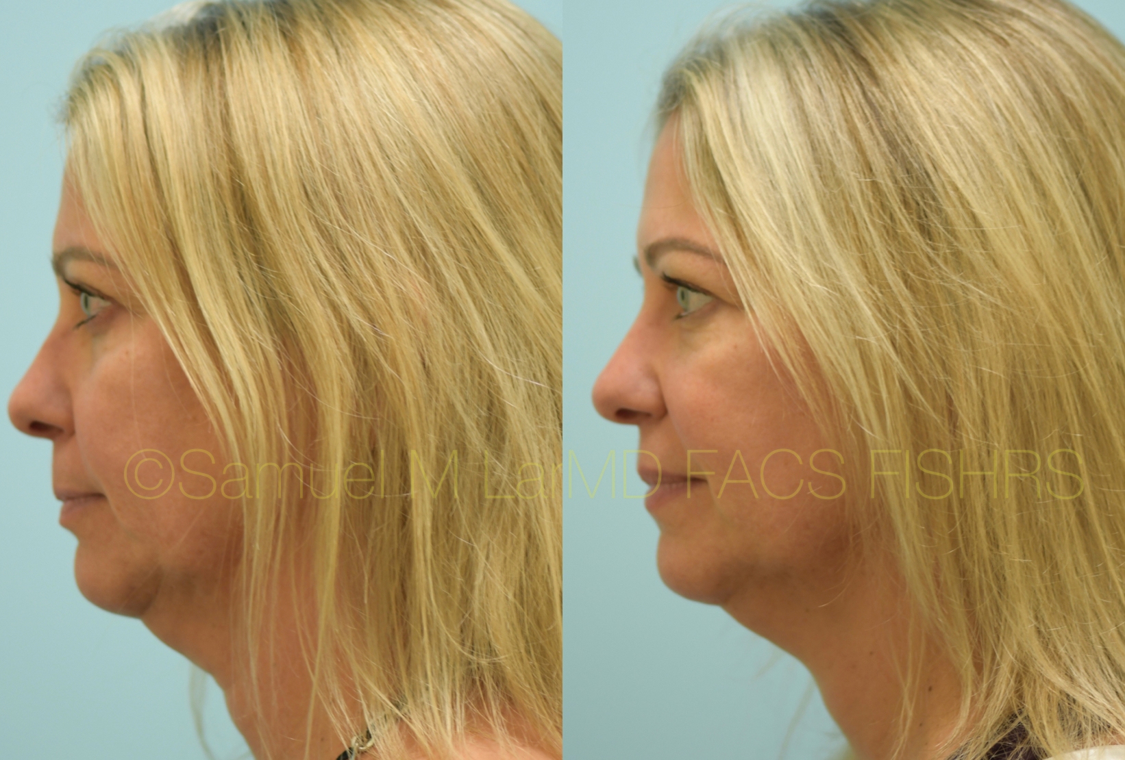 Botox