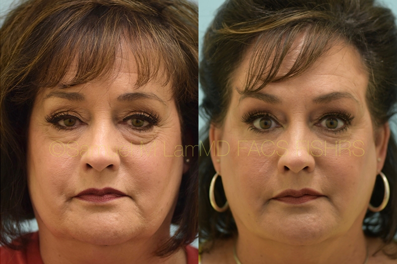 Eyelid Rejuvenation, Fat Grafting