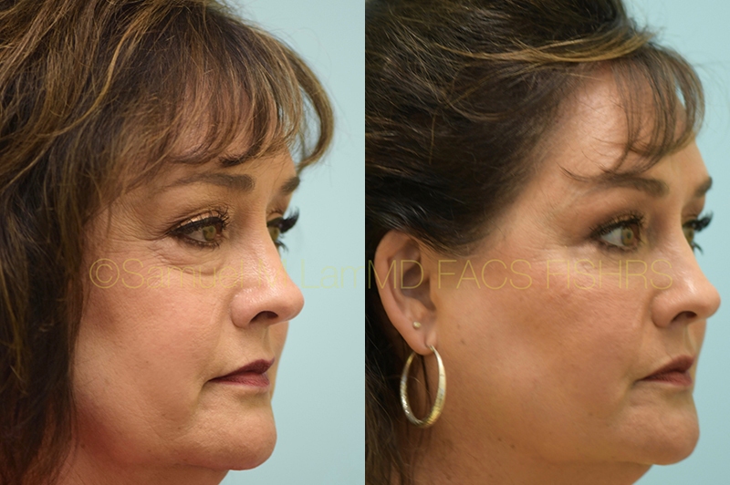 Eyelid Rejuvenation, Fat Grafting