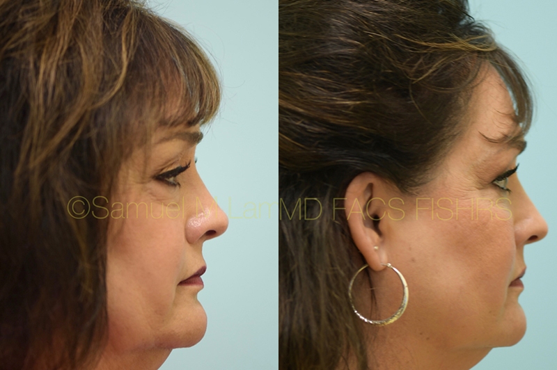 Eyelid Rejuvenation, Fat Grafting