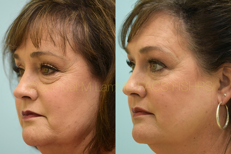 Eyelid Rejuvenation, Fat Grafting