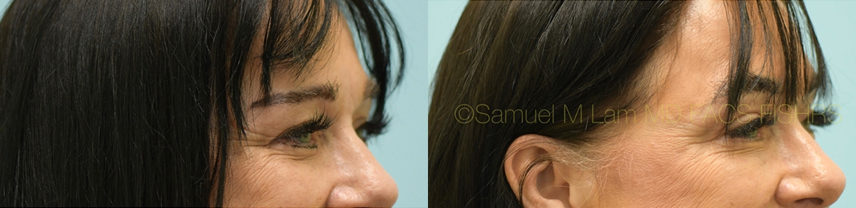 Eyelid Rejuvenation