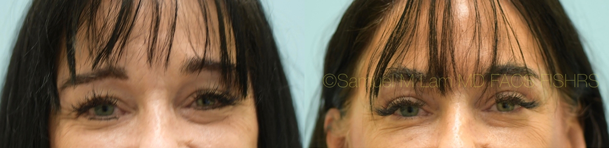 Eyelid Rejuvenation