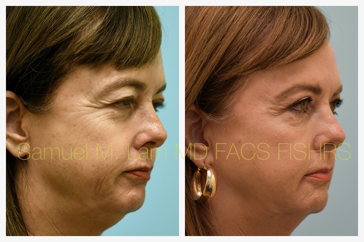 Eyelid Rejuvenation, Botox, and Fillers Before and After Photo by Dr. Lam in Plano, TX