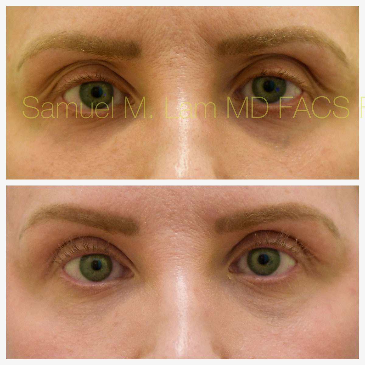 Blepharoplasty, eyelid rejuvenation Before and After Photo by Dr. Lam in Plano, TX