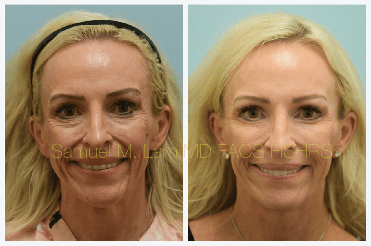 Facelift Blepharopalsty Fat Grafting Before and After Photo by Dr. Lam in Plano, TX
