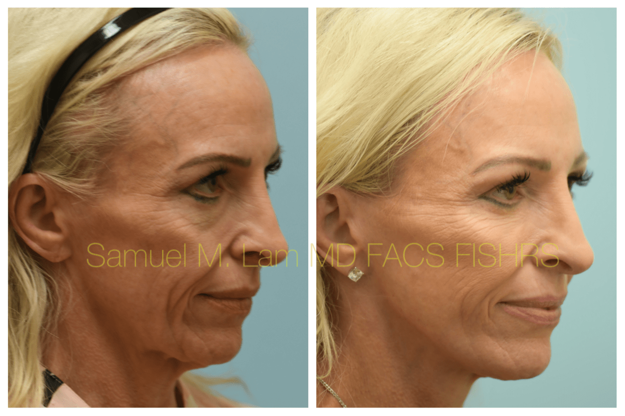Facelift Blepharopalsty Fat Grafting Before and After Photo by Dr. Lam in Plano, TX