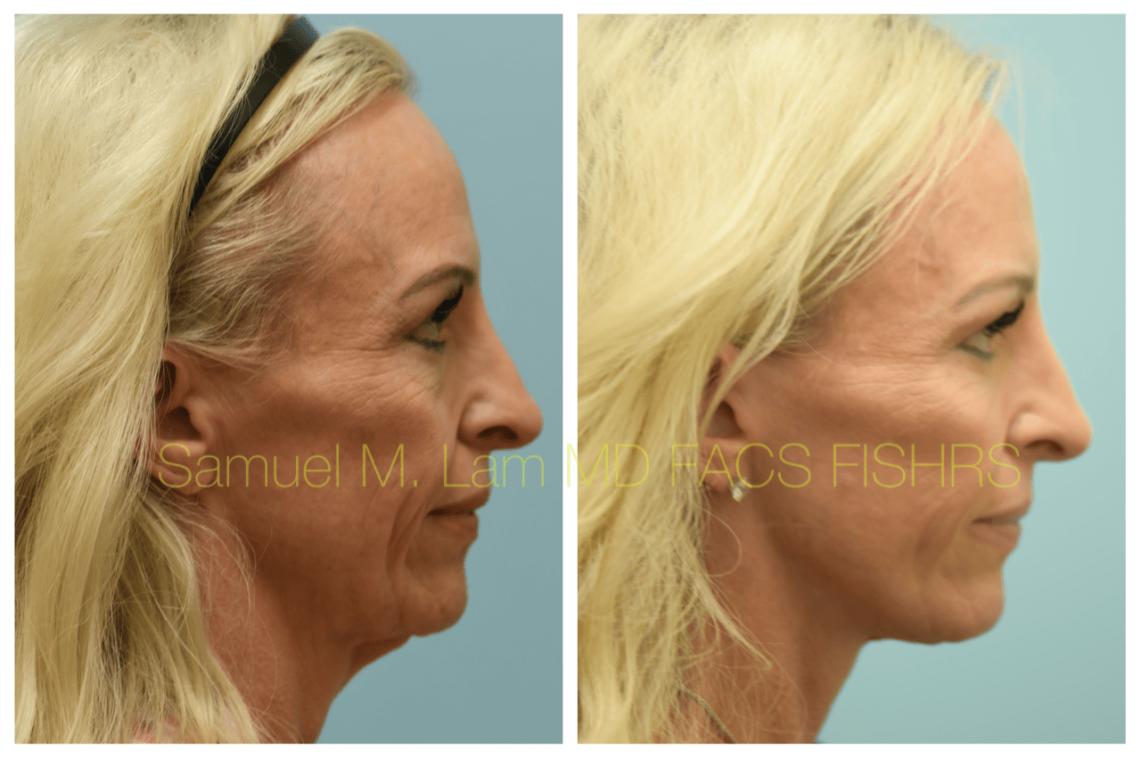 Facelift Blepharopalsty Fat Grafting Before and After Photo by Dr. Lam in Plano, TX