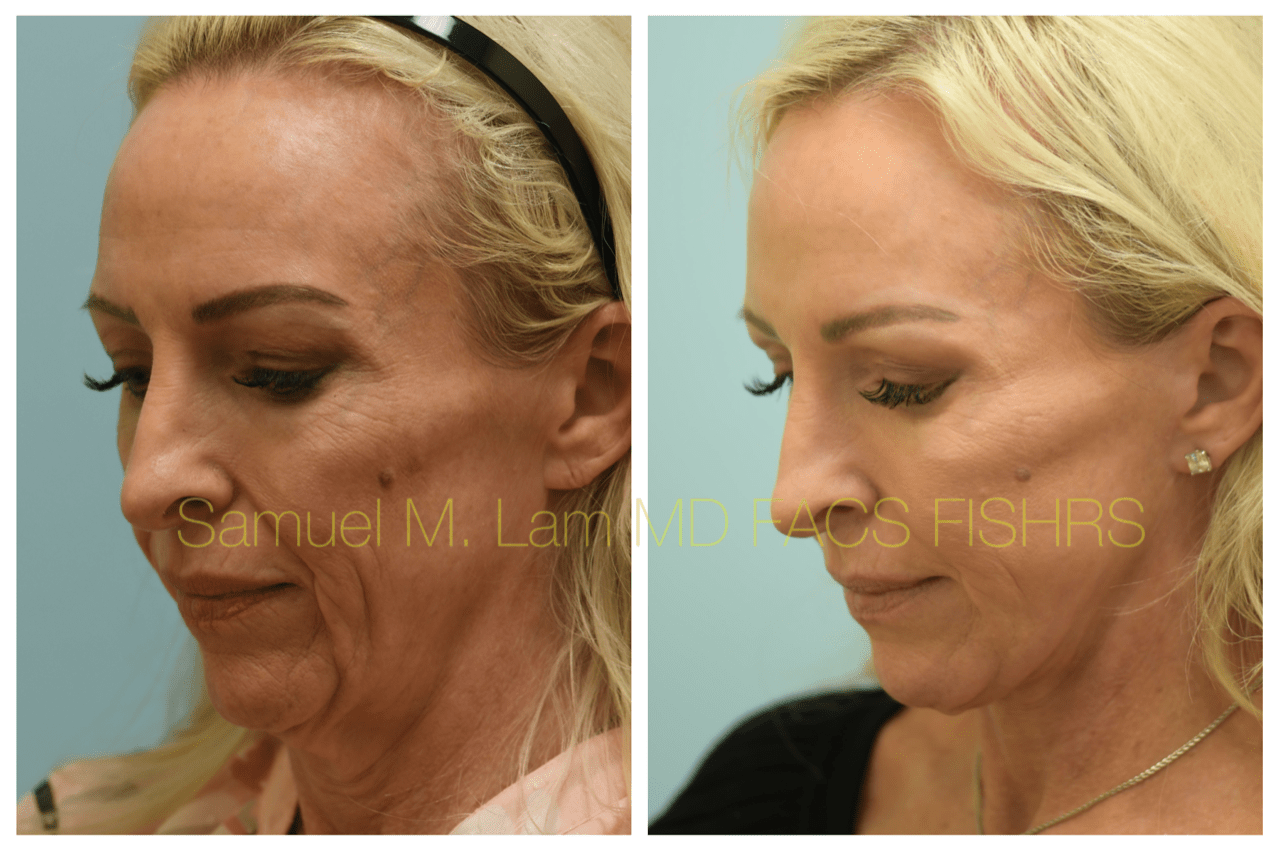 Facelift Blepharopalsty Fat Grafting Before and After Photo by Dr. Lam in Plano, TX