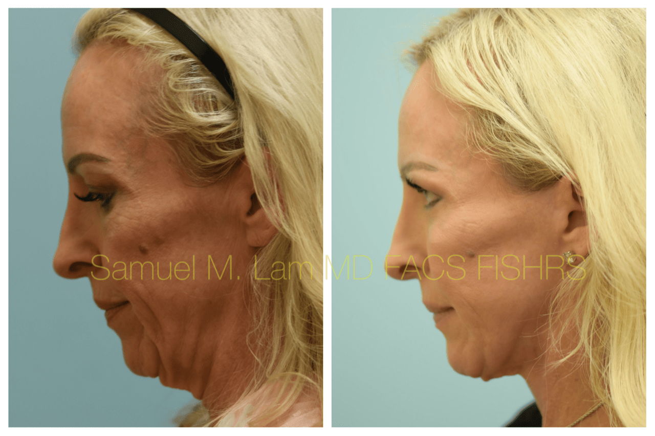 Facelift Blepharopalsty Fat Grafting Before and After Photo by Dr. Lam in Plano, TX