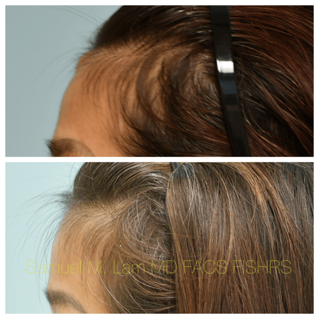 Osteoma Before and After Photo by Dr. Lam in Plano, TX