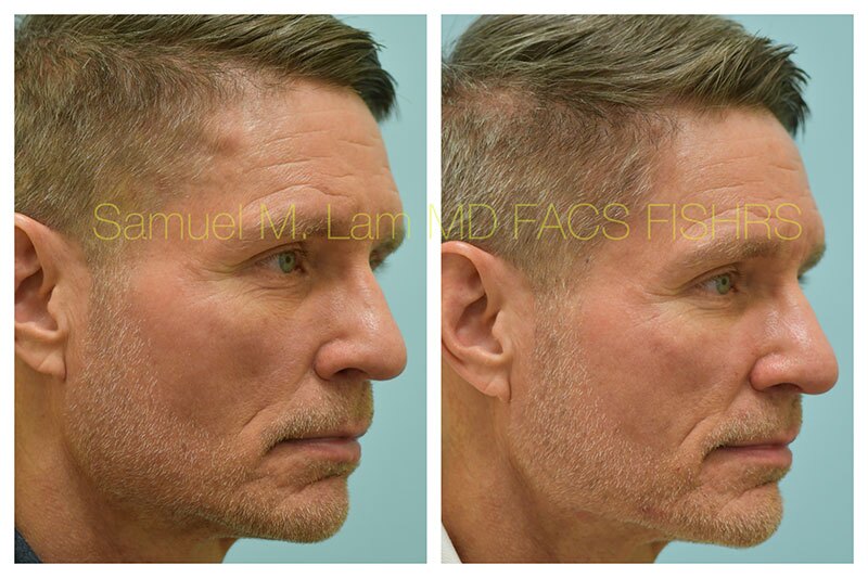 Osteoma Before and After Photo by Dr Lam in Plano TX
