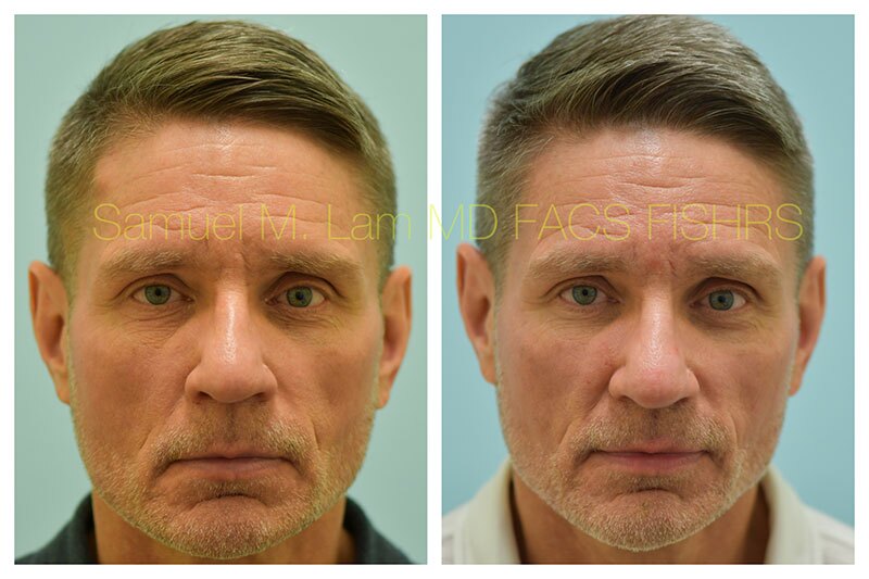Osteoma Before and After Photo by Dr Lam in Plano TX