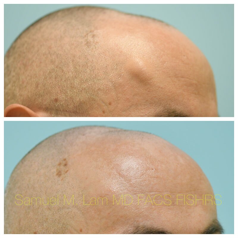Osteoma Before and After Photo by Dr Lam in Plano TX