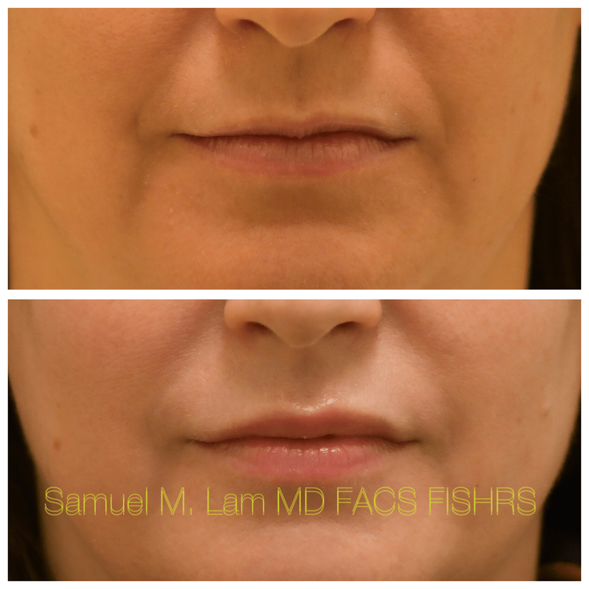 Lip Filler Before and After Photo by Dr. Lam in Plano, TX